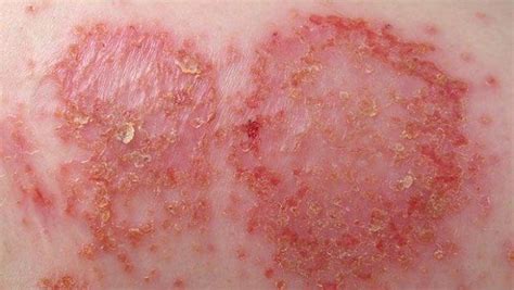 common skin disorders - pictures, photos