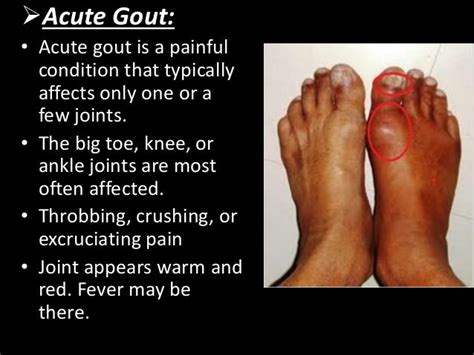 Ankle injury gout- Read More Articles,Guides,Doctor Advices