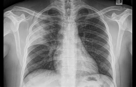 Lobar pneumonia - Critical Care Sonography