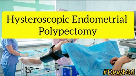 Hysteroscopic Endometrial Polypectomy | Uterine Polyp Removal | #DewMal ...