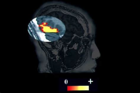 Cortical Vision Impairment: Assessment and Intervention | Vision ...