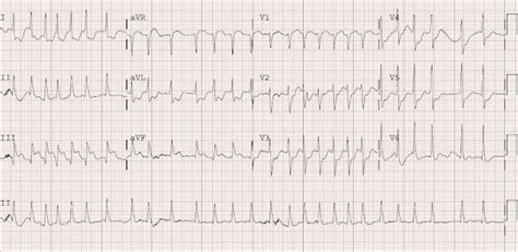 Dr. Smith's ECG Blog: Atrial Fibrillation with RVR and Inferoposterior ...