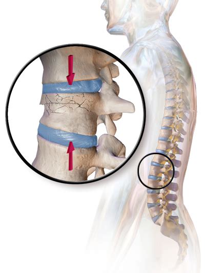 Vertebral compression fracture - Wikipedia