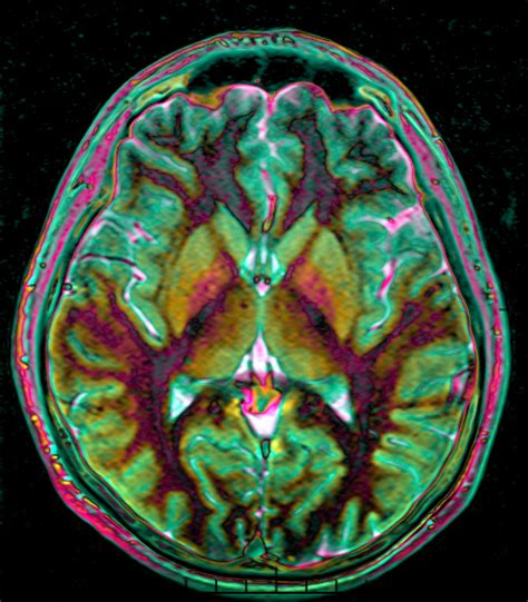 File:Max contrast Brain MRI 131058 rgbcb.png - Wikimedia Commons