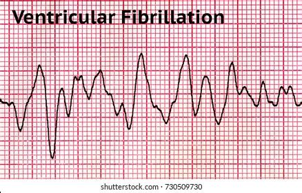 Categoría «Fibrilación ventricular» de fotos de stock, 2,545 imágenes ...