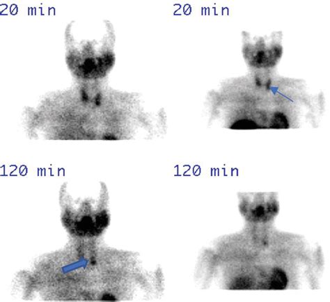 Parathyroid Scintigraphy | IntechOpen