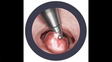 Endometrial Polypectomy with HTRs (Hysteroscopic Tissue Removal system ...