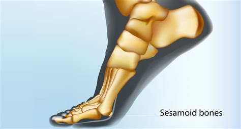 Sesamoid Bone Foot Fracture