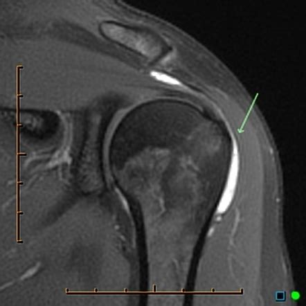 Subdeltoid Bursitis Mri