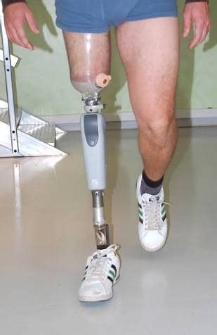 Computerized Above Knee Prosthesis/Leg, Artificial Limbs, कृत्रिम अंग ...