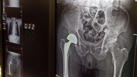 Hip fracture recovery ‘varies between hospitals’ – study