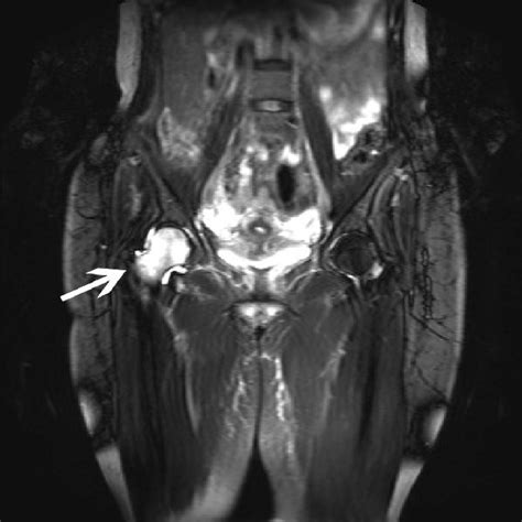 Mri 3 months later showing significant regression of the right hip ...