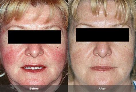 Rosacea Treatment Photos | Rosacea.org