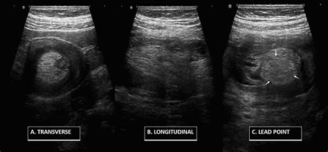 Lipoma Ultrasound Treatment - Infoupdate.org