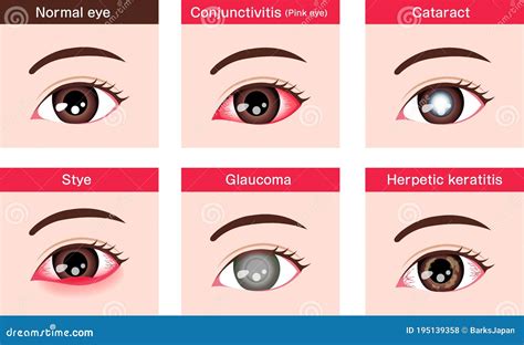 Various Eye Diseases Vector Illustration Female Eye Stock Vector ...