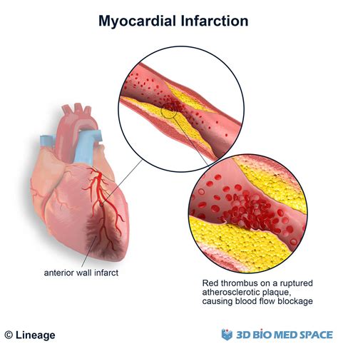 Myocardial Infarction - Cardiovascular - Medbullets Step 2/3