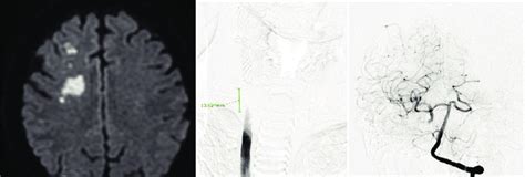 (a) MRI showed scattered infarction of the right cerebral hemisphere ...