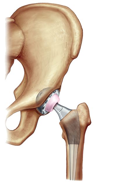 Total Hip Replacement – exac.com.au