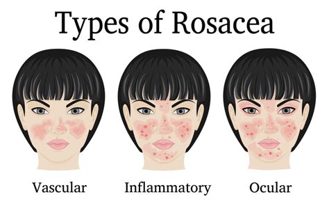 Natural Treatment for Rosacea | Vitalia