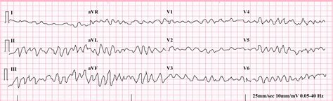 ECG Educator Blog : Ventricular Fibrillation (VF)