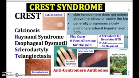 CREST SYNDROME: crest syndrome - causes, symptoms, treatment, usmle ...