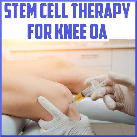 Stem Cell Treatment for Knee Osteoarthritis - Sports Medicine Review