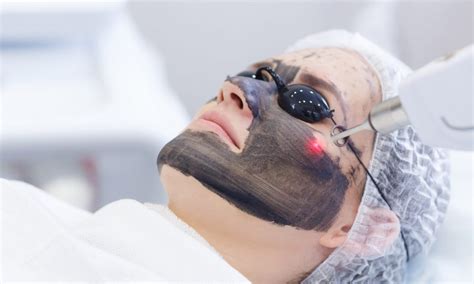 What are the Benefits of a Carbon Laser Facial?