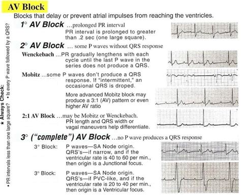 Conduction Blocks at the AV Node (AV Blocks) [With Examples] - Manual ...