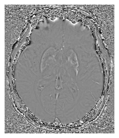 MRI changes in the left corpus striatum related to hemichorea ...