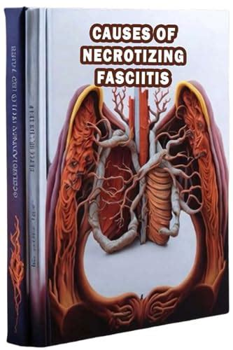 Causes of Necrotizing Fasciitis: Understand the causes of necrotizing ...