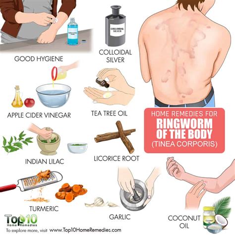 How to Get Rid of Ringworm (of the Body)