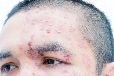 Shingles - treatments, symptoms and causes | healthdirect