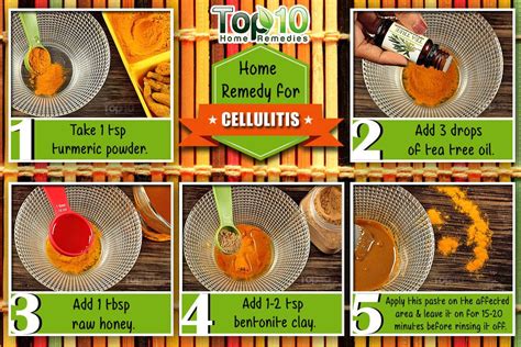 Home Remedies for Cellulitis | Top 10 Home Remedies