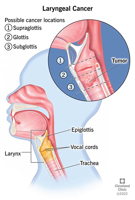 Laryngeal Cancer: Symptoms, Causes & Treatment