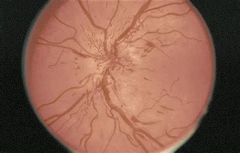 Optic disc edema - American Academy of Ophthalmology