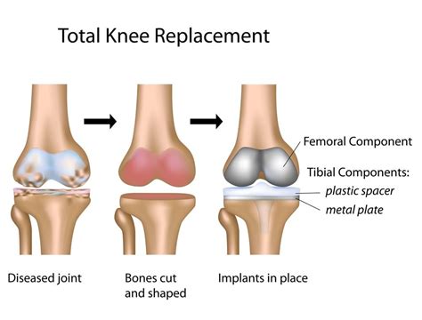 Total Knee Replacement – Pacific Bone & Joint Clinic