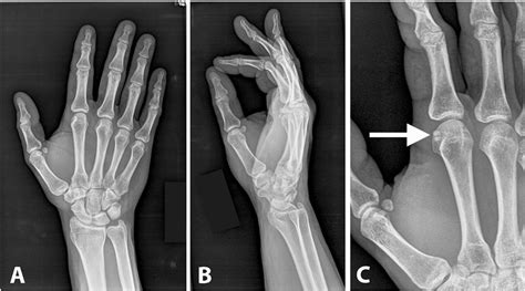 Sesamoid Bone Fracture