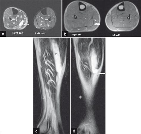 Rupture of Plantaris Muscle - A Mimic: MRI Findings - Journal of ...