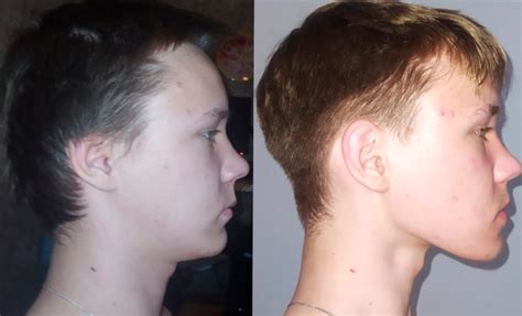 Mewing for Jawline: The Complete Guide for Exercises