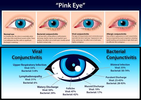 Signs And Symptoms Of Pink Eye Vs Allergies