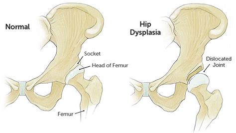 Hip Dysplasia