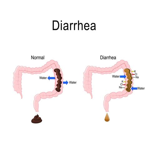 Diarrhea - Harvard Health