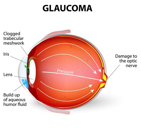 Prosthetic Eye for Glaucoma | Ocular Prosthetics, Inc.