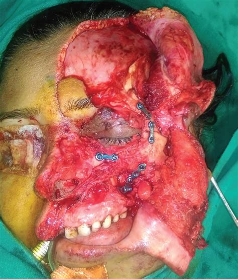 Primary One Stage Reconstruction in Complex Facial Avulsion Injury ...