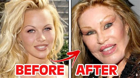 Celebrity Plastic Surgery Before And After Pics - Infoupdate.org