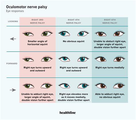 Cranial Nerve Palsy – CN III, IV, VI VII Palsy, 57% OFF