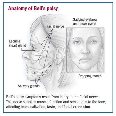 Facial palsy causes – Telegraph