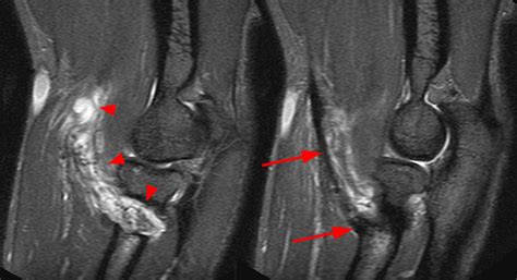 Biceps Tendon Tear Elbow Mri