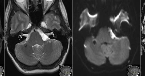 Radiology MRI: Epidermoid Cyst DWI