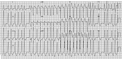 Afib With Rvr Treatment